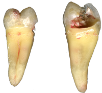 Karies durch sogenannte Löcher