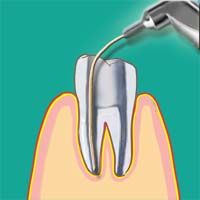 Laser bei der Wurzelbehandlung