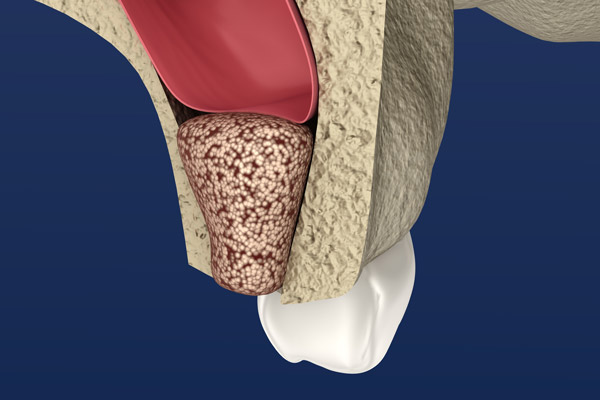 Sinus Lift
