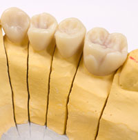 metallfreie Restauration