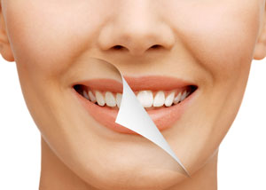 Bleaching Sichere Zahnaufhellung in der Zahnarztpraxis Dr. Gorden & Dr. Poll Dortmund - In-Office-Bleaching & Kombibehandlung 