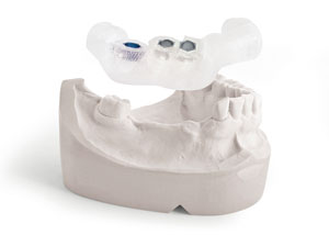 Navigierte Implantation