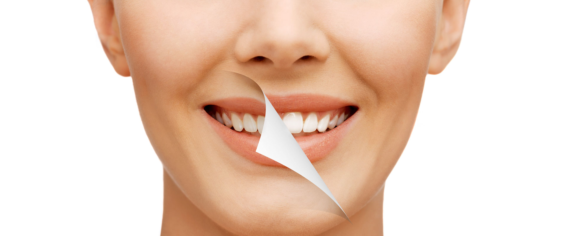 Bleaching · Sichere Zahnaufhellung in der Zahnarztpraxis - In-Office-Bleaching & Kombibehandlung Dr. Gorden & Dr. Poll in Dortmund 