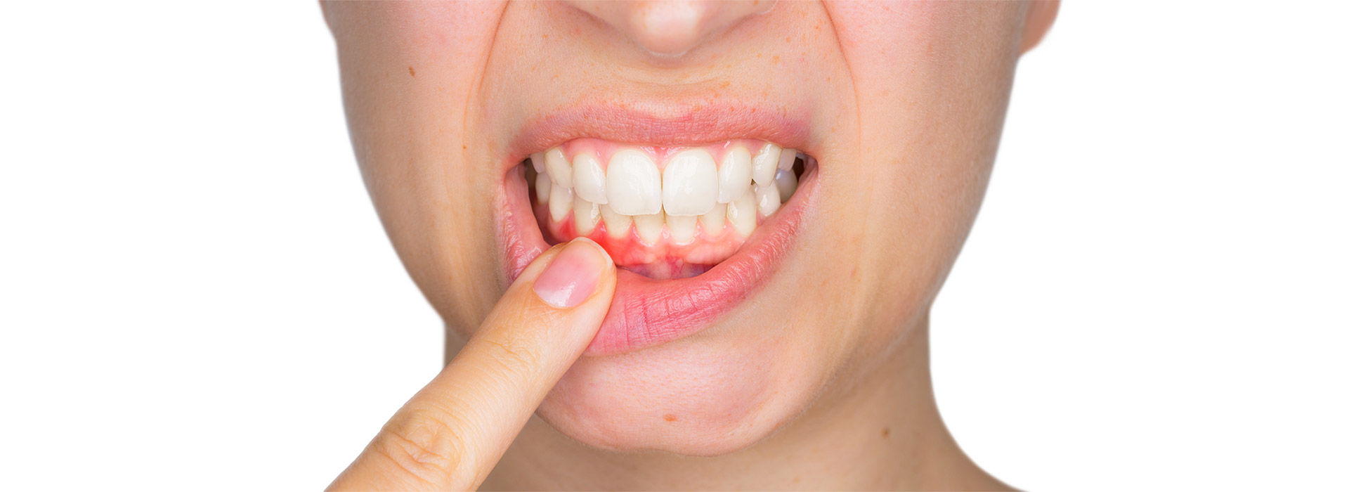 Wurzelbehandlung Endodontie Zahnerhalt Dr. Gorden & Poll Dortmund Zahnärzte