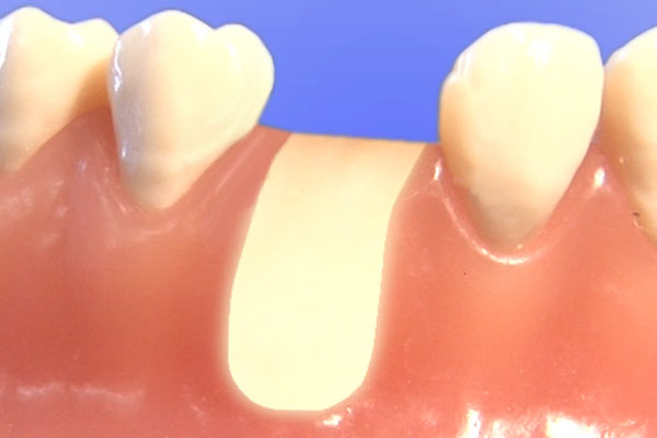 Knochenaufbau (Augmentation) · Gemeinschaftspraxis für Zahn-, Mund- und Kieferheilkunde Dr. Gorden & Dr Poll