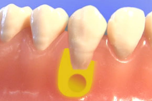 Wurzelspitzenresektion (WSR) · Gemeinschaftspraxis für Zahn-, Mund- und Kieferheilkunde Dr. Gorden & Dr Poll